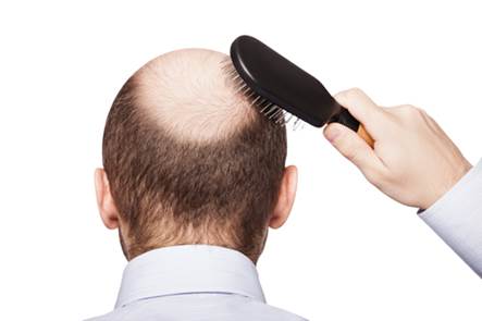 Nguyên nhân của chứng rụng tóc gây hói đầu