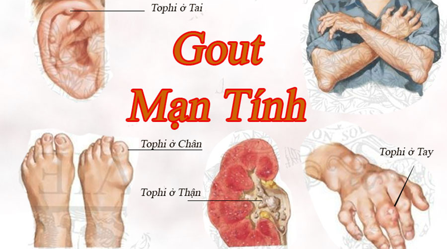 Một số điều cần biết cho bệnh nhân Gout (gút)